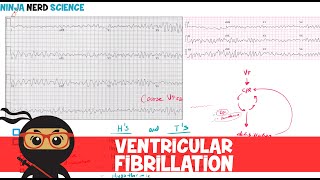 Rate and Rhythm  Ventricular Fibrillation [upl. by Tyrone656]