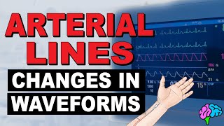 Common Changes in Arterial Line Waveforms [upl. by Nitsraek]