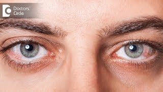 Eye Allergy Causes Signs and Symptoms Diagnosis and Treatment [upl. by Trula841]