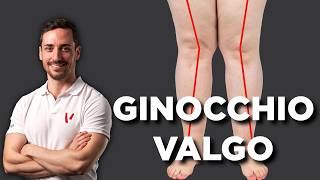 Ginocchio valgo esercizi correttivi [upl. by Allwein]