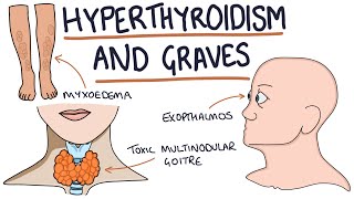 Understanding Hyperthyroidism and Graves Disease [upl. by Selima]