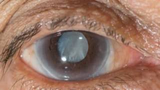 New eye drops may help treat cataracts [upl. by Leirej]