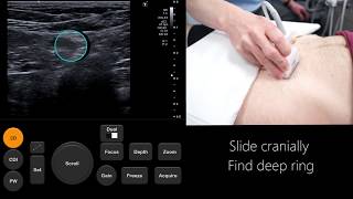 Ultrasound Tutorial Kidney amp Bladder  Urinary Tract  Radiology Nation [upl. by Stanfield]