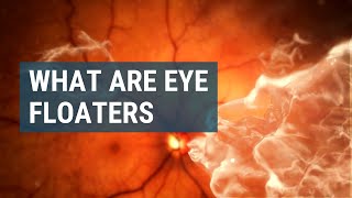 What Are Eye Floaters [upl. by Roberts]