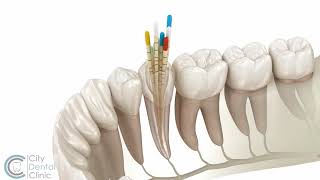 Endodontics  Root canal treatment  City Dental Clinic Bratislava [upl. by Enyar]