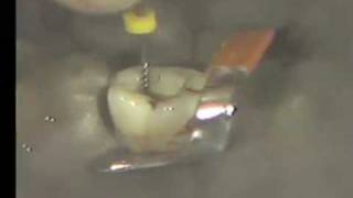 Cleaning and Shaping Root Canal  Curved Canal [upl. by Pablo937]