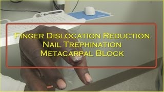 Thumb Dislocation and Reduction Medical Education amp Training [upl. by Eivol]