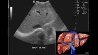 Hydrocele Embryology types clinical features examination surgeries Surgery MedVidsMadeSimple [upl. by Remy]