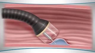 Iron Saturation  Low High Causes Treatment [upl. by Akihdar]