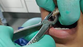 Painless and Easiest method for tooth extraction [upl. by Sucramrej349]