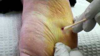 Surgical Plantar Wart Removal [upl. by Chainey]