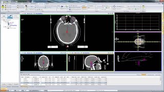 Setting Up a Plan for Multiple Brain Metastasis using Monaco [upl. by Veradi]