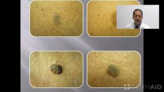 Seborrheic Keratoses [upl. by Yelir]