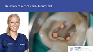 Revision of a root canal treatment [upl. by Rehtse449]