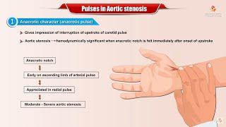 PULSES IN AORTIC STENOSIS  Usmle Cardiology [upl. by Fredra216]