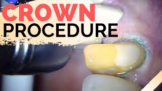 Dental Crown Explained  Anterior Crown Preparation [upl. by Hogan]