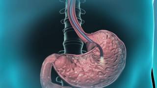 Learn about gastroscopy [upl. by Ayat]