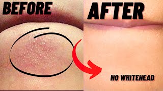 How To Remove Whiteheads And Blackheads From Chin At Home [upl. by Yenobe493]