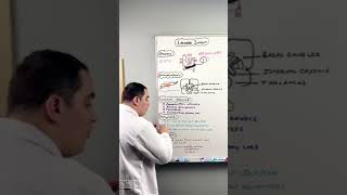 Ischemic Stroke  Lacunar Infarct shorts [upl. by Eniarda]