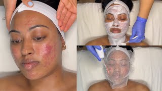 CYSTIC ACNE TREATMENT  WALKIN FACIAL FOR GRADE 3 AND 4 ACNE WITH PRO TIPS  LICENSED ESTHETICIAN [upl. by Nerradal118]