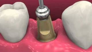 Restoring BioHorizons Dental Implants 2011 [upl. by Amalberga474]