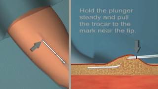 Jadelle insertion and removal Tutorial [upl. by Olnay931]