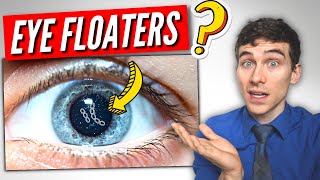 3 Must Know Facts About EYE Floaters [upl. by Gresham933]