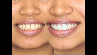 How to Whiten Teeth  DIY  Turmeric and Coconut oil [upl. by Leviram]