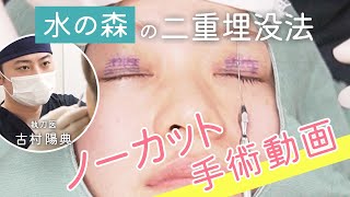 【手術動画】水の森の二重埋没手術に密着！ [upl. by Nerland]