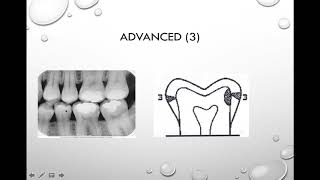 Interpretation of Dental Caries Source [upl. by Enelrae]