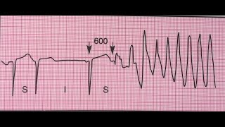 Torsades de pointes tachycardie ventriculaire [upl. by Finella417]