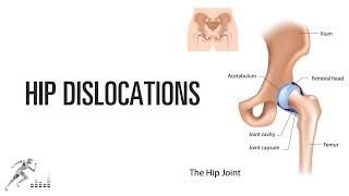 Hip dislocation [upl. by Sussna]