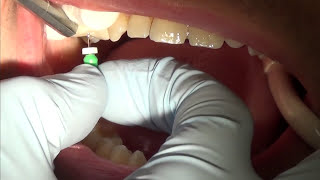 root canal treatment part 1 [upl. by Eiknarf]