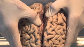 What is a Cerebral Contusion [upl. by Alysoun]