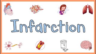 Infarction  Causes Types Morphology amp Factors influencing development of infarction [upl. by Monti]