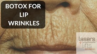 BOTOX for lip wrinkles [upl. by Nnylaehs]