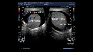 How To Renal Ultrasound  Hydronephrosis Case Study Video [upl. by Hathaway]