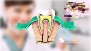 What is a Root Canal Treatment [upl. by Ative]