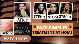 Face Pimples Treatment At Home  ACNE TREATMENT  Pimples Kese Hataye  shivammalik [upl. by Duwad]