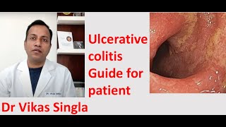 Ulcerative colitis Treatment and Symptoms अल्सरेटिव कोलाइटिस In Hindi Dr Vikas Singla [upl. by Notlek]