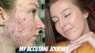 MY ISOTRETINOIN ACCUTANE JOURNEY  BEFORE AND AFTER PHOTOS [upl. by Wunder]