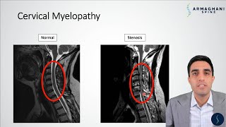 Top 10 Cervical Neck Disc Herniation Exercises amp Stretches for Pain Relief [upl. by Eednak]