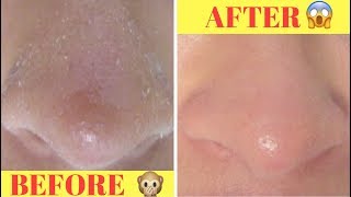 DIY 5 minute DRY SKIN ON NOSE RECIPE‼️ [upl. by Bearce]