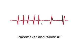 Pacemakers and quotslowquot AF patients [upl. by Egap645]