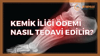 KEMİK İLİĞİ ÖDEMİ NASIL TEDAVİ EDİLİR [upl. by Einal348]