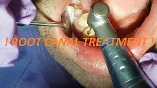 ROOT CANAL TREATMENT [upl. by Airamanna]