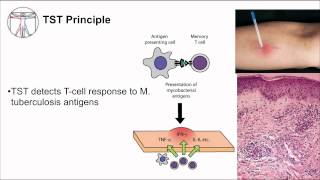 Tuberculosis Diagnosis [upl. by Aylward801]