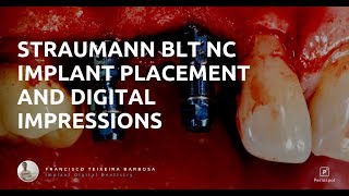 Straumann BLT Implant Placement and Digital Impressions [upl. by Ecnarrat]