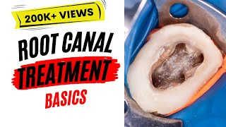 Root Canal Treatment Basics  StepbyStep [upl. by Loris]