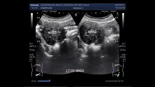 Breast cancer classification by Dr Devesh Mishra [upl. by Anahsak156]